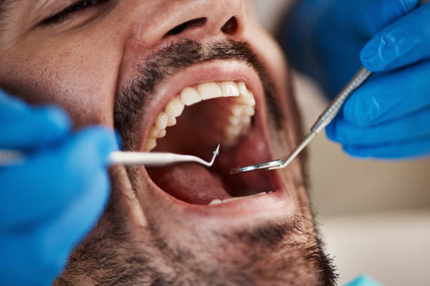 Best Urgent Care for Lost Fillings or Crowns in Union, SC